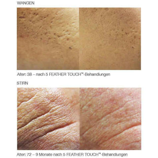 Feather Touch™ - beeindruckende Ergebnisse